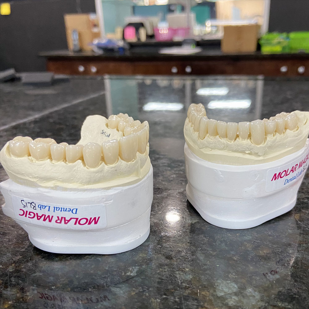 molar-magic-dental-lab_services_crown-and-bridge