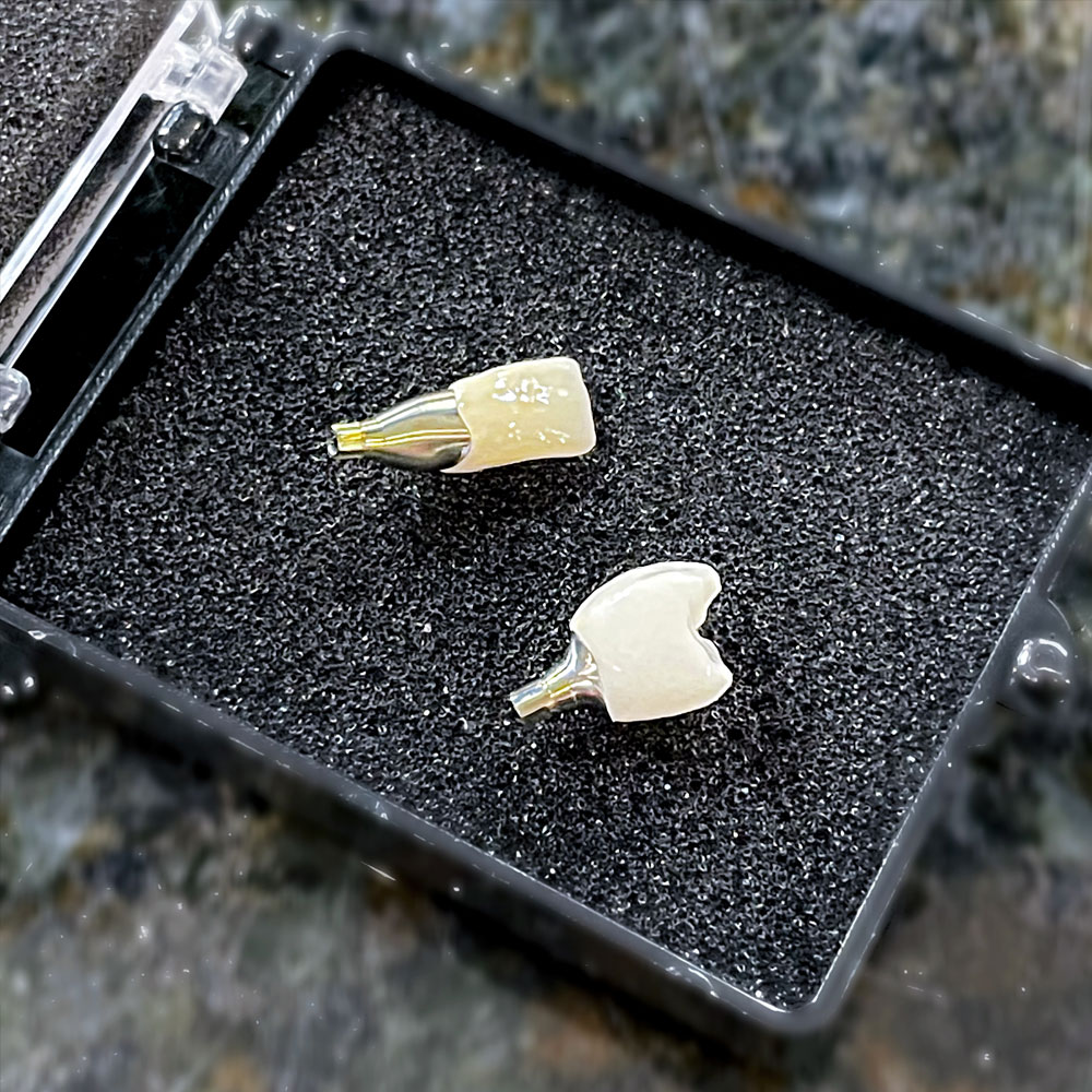 molar-magic-dental-lab_services_implants